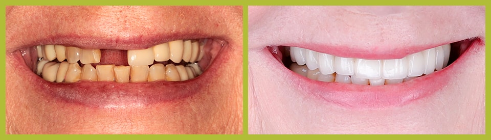 Actual Before and After of porcelain veneers case from our Smile Gallery