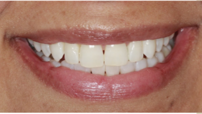 Serene Dentistry Teeth Whitening After