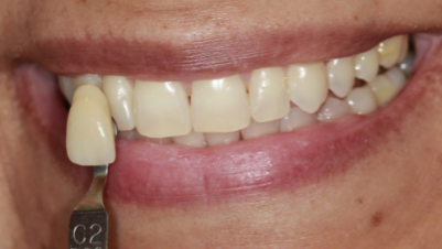 Serene Dentistry Teeth Whitening Before