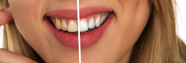 before and after tooth whitening