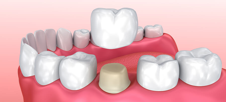 illustration of a dental crown