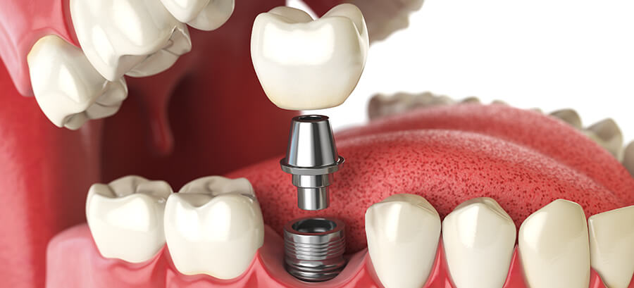 illustration of a dental implant