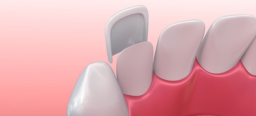 illustration of a dental veneer