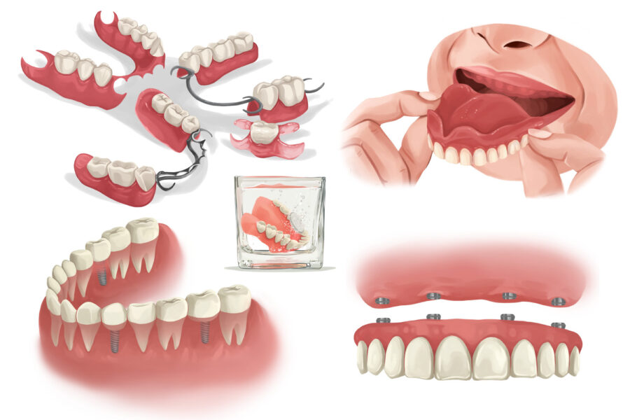 Drawings of full, partial, and implant-supported dentures and single dental implants