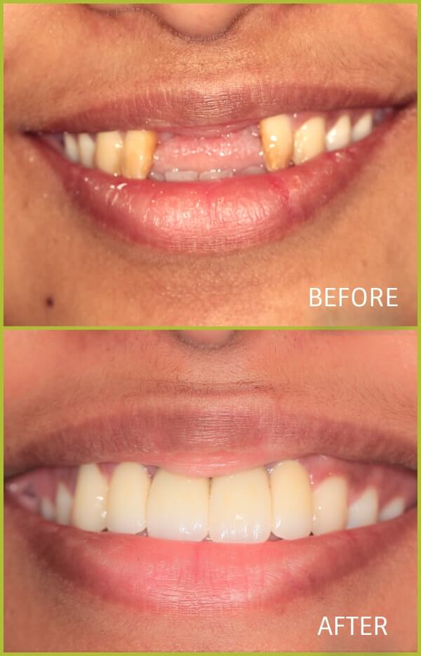 before and after dental implants