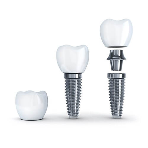 illustration of dental implants