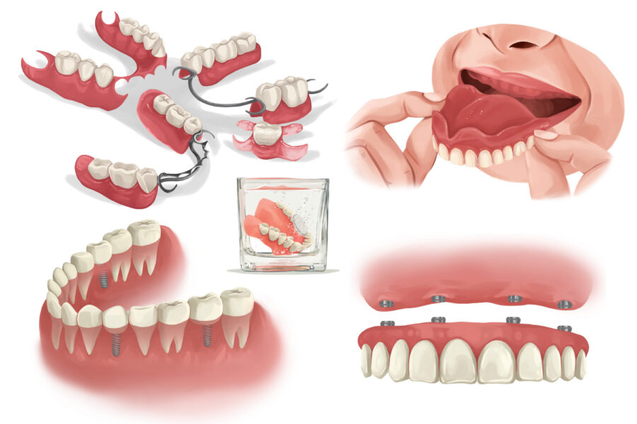 Illustration of different configurations of dental implants and dentures to replace missing teeth in McKinney, TX