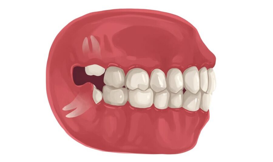 Illustration of a mouth with 2 problematic wisdom teeth that need to be removed