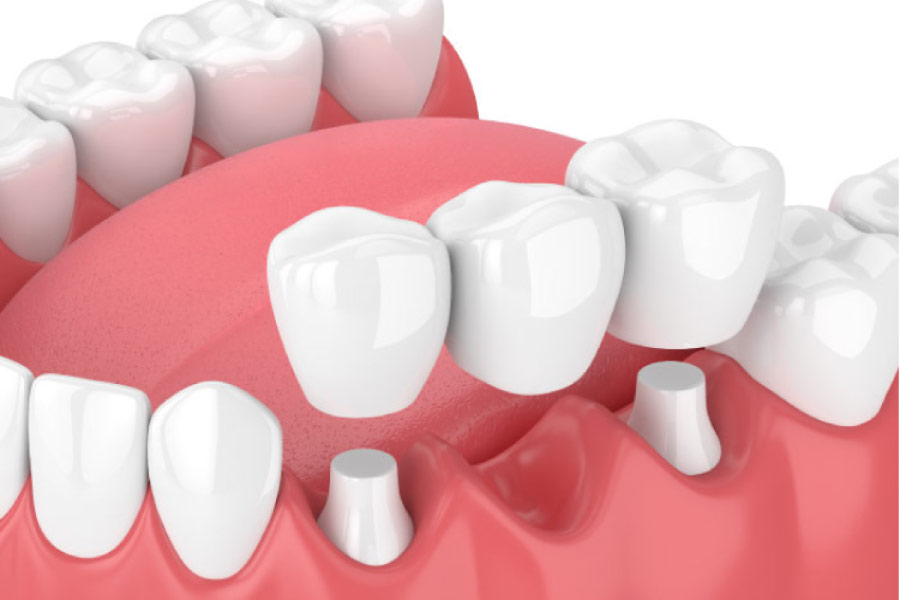 dental implant supported bridge model