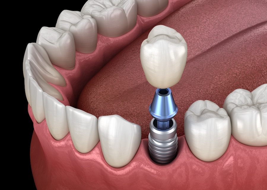 dentures vs. dental implants, Serene Dentistry, McKinney TX dentist, tooth replacement options, dental implants benefits, dentures benefits, Dr. Jay, Dr. Roberts, Dr. Middleton, Dr. Morrison