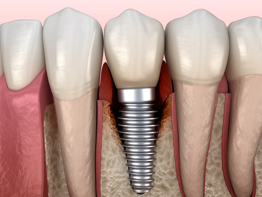 loose dental implant, dental implant issues, McKinney dental implant, saving dental implants, bone loss, implant adjustment, peri-implantitis, implant repair, dental health solutions