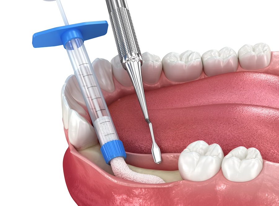 dental bone graft, bone graft types, dental implant support, Serene Dentistry, McKinney TX, bone grafting