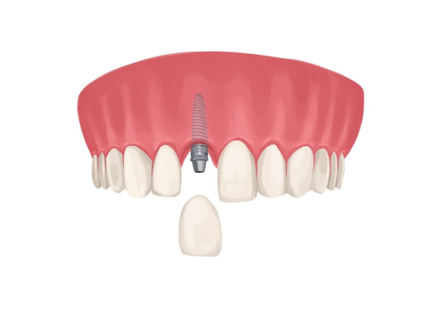 implant crown on dental implant, implant crowns, traditional crown